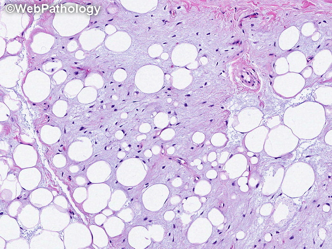Soft Tissue_Lipomatous_Lipoblastoma26_resized.jpg